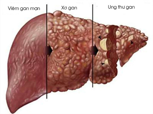 Nấm Lim Xanh chữa bệnh viêm gan